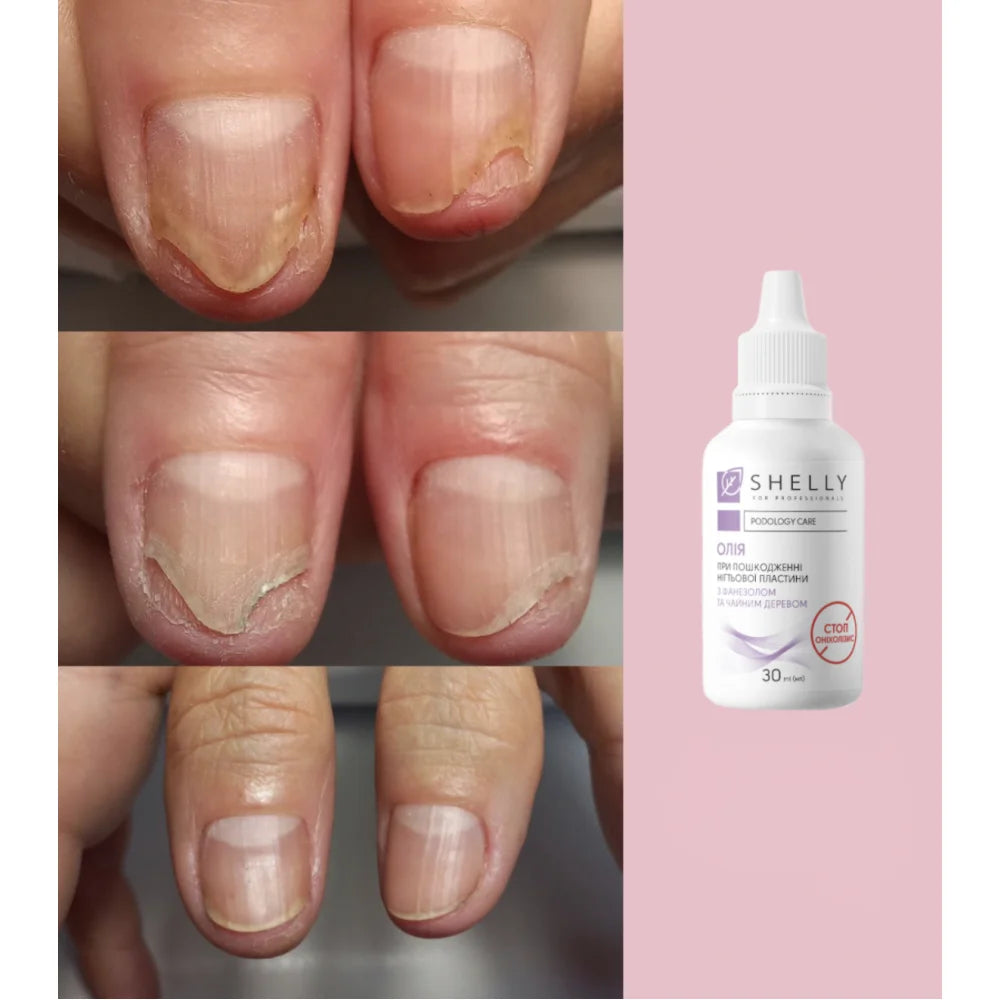 Shelly Stop Onycholysis Nail Recovery Oil with Tea Tree, Eucalyptus & Farnesol 30 ml